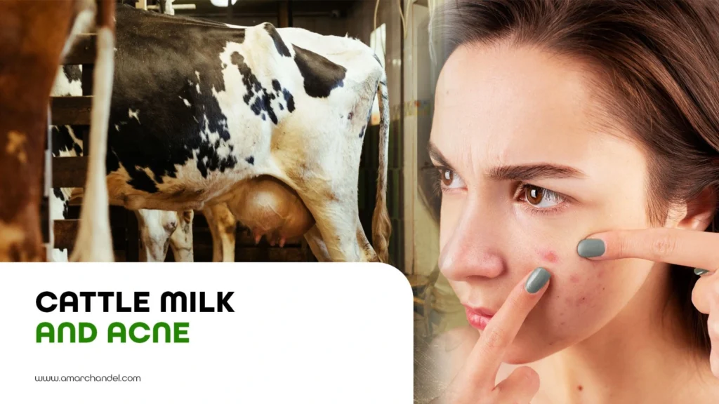 Cattle Milk and Acne